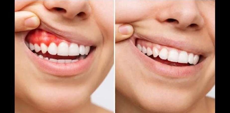 Salud adhiere al D�a Internacional de las Enc�as